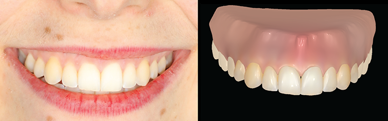 Disney Research Software Turns Photos Into Digital Dental Impressions
