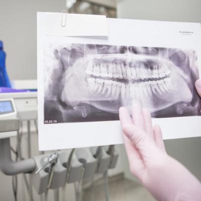 Zblizenie Rentgenowskie Szczeki W Rekach Nie Do Poznania Dentysty 118628 2753